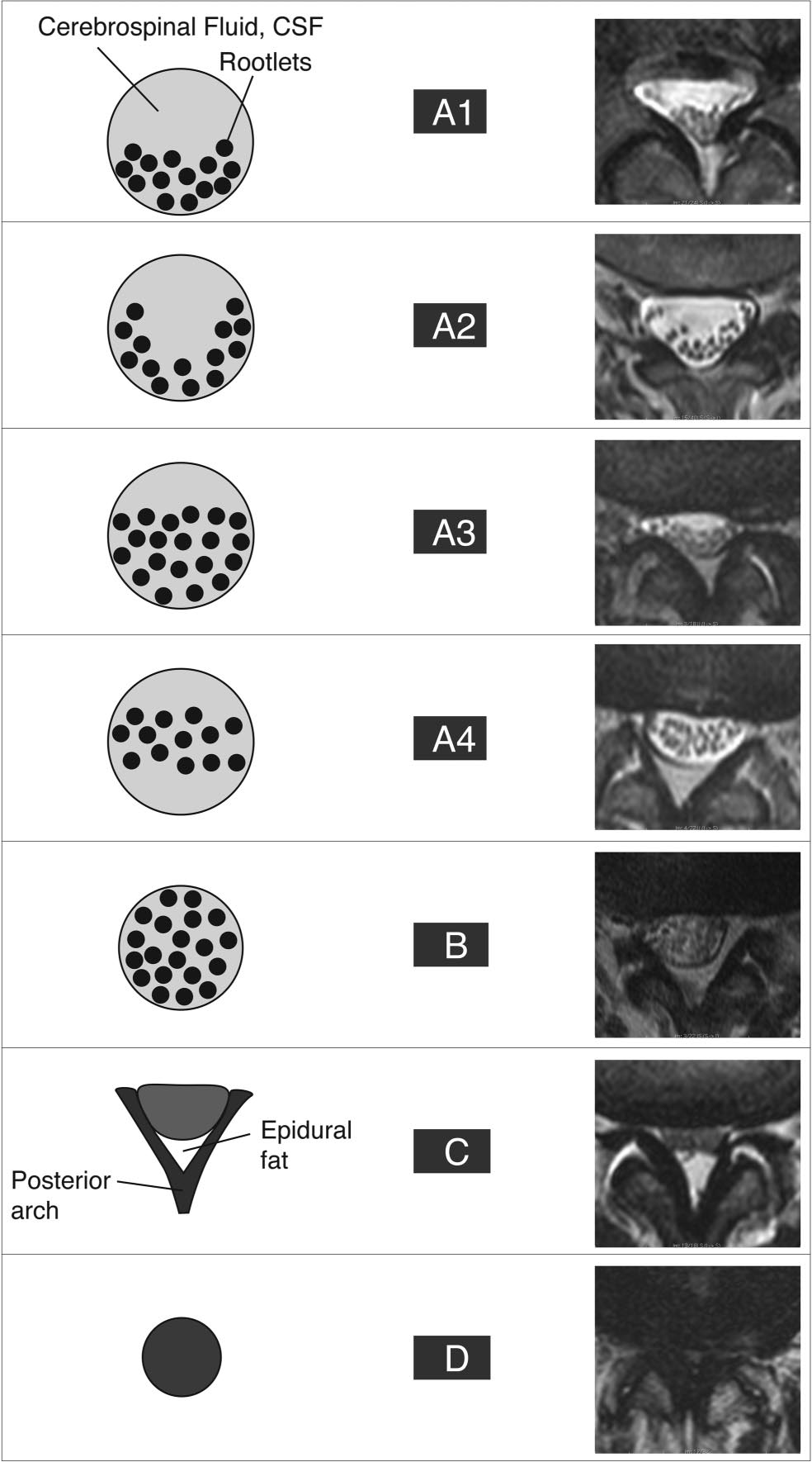 The complete Schizas classification: schematic and matched MRI for grades A1 to D