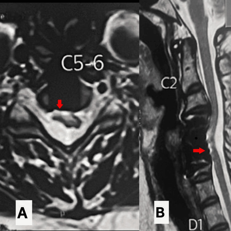 Axial and sagittal T2 showing a thinned cord with restored CSF space