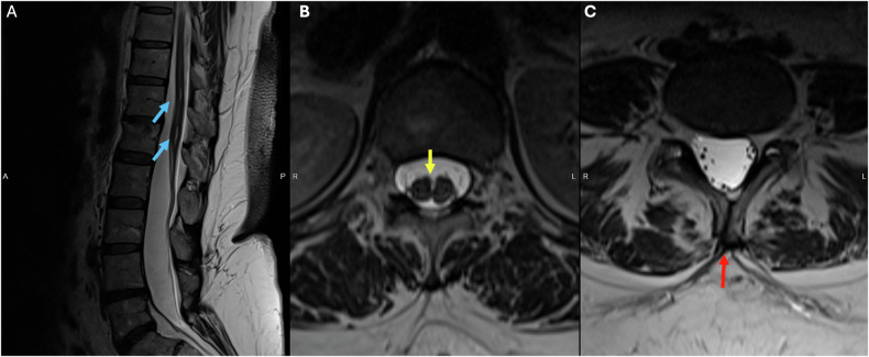 Sagittal and axial T2 showing a syrinx, duplicated dural sac and incomplete posterior fusion