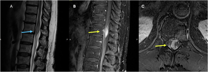 Sagittal T2 and post-contrast images of an expanded, enhancing conus