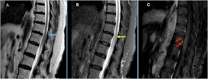 Sagittal T2, STIR and post-contrast T1 showing an abnormal conus