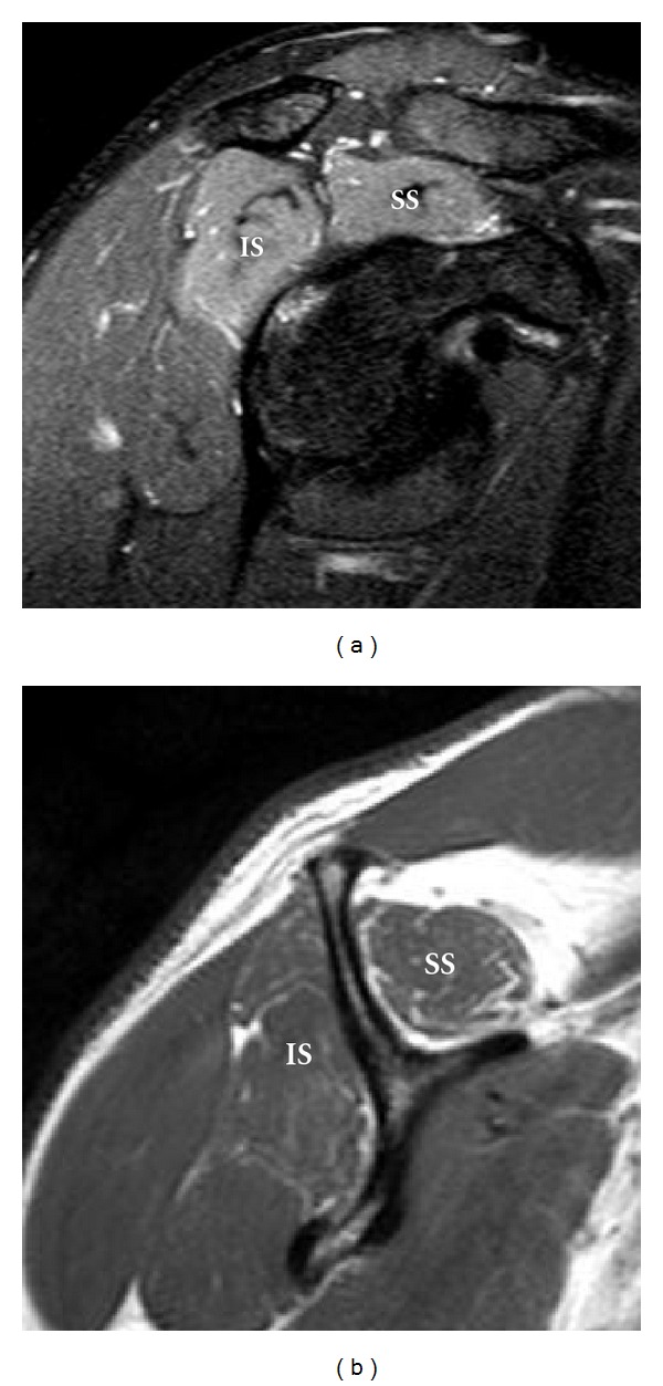 T2 fat-saturated and T1 images of the same denervated muscles