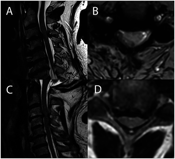Two patients with the same degree of cord compression, one myelopathic and one not