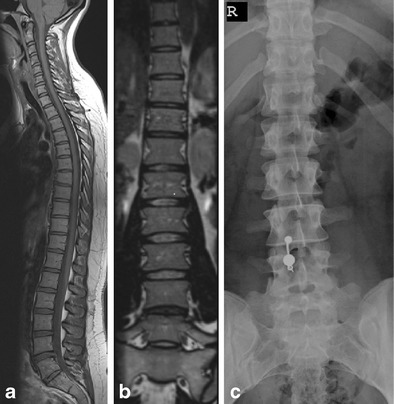 Sacralised L5 on whole-spine sagittal MRI, coronal MRI and radiograph