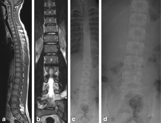 Lumbarised S1 on whole-spine sagittal MRI, coronal MRI and radiographs