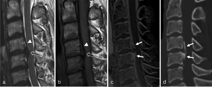 Sagittal T2, T1, gradient echo and CT of the same cervical spine showing OPLL