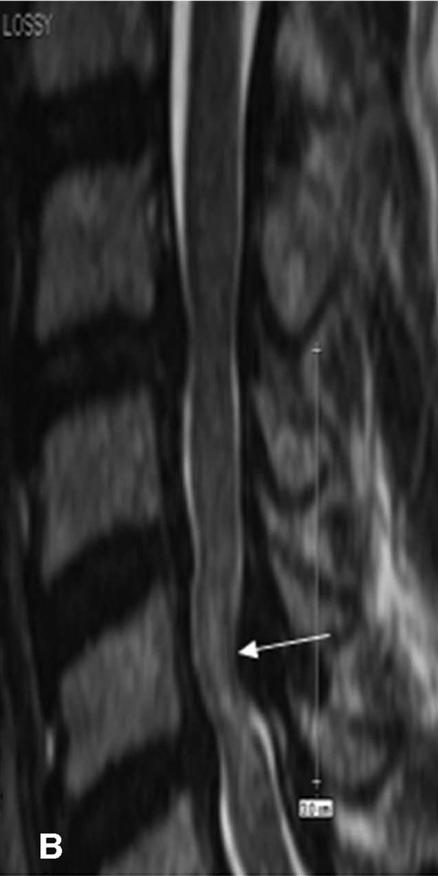 Diffuse T2 cord signal