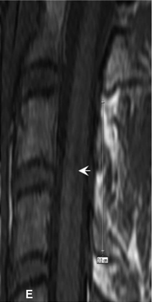 Low T1 signal in the cord
