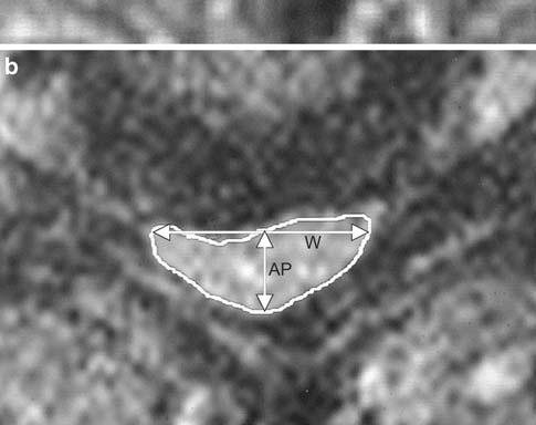 Banana-shaped cord with compression ratio 0.37