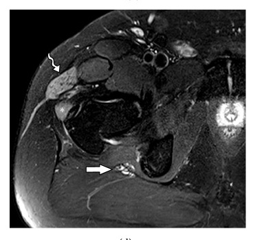 Axial T2 fat-saturated showing unilateral muscle oedema with both sides in frame