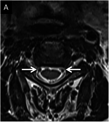 Axial T2 with flow-related signal loss around the cord