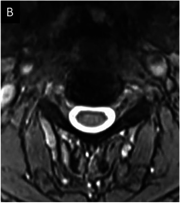 Axial GRE at the same level, CSF uniformly bright