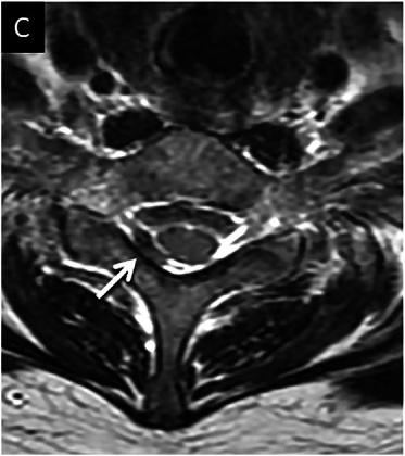 Axial T2 with an eccentric dark spot beside the cord