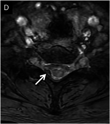 Axial gradient echo showing the same spot blooming larger and blacker