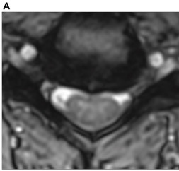 Focal ventral impingement, CSF preserved