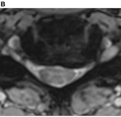Flattened cord, partial CSF loss