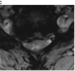 Severe circumferential compression, CSF effaced