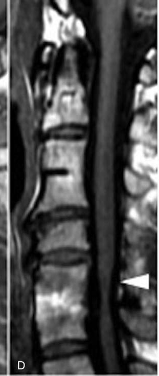 New T1 hypointensity after surgery