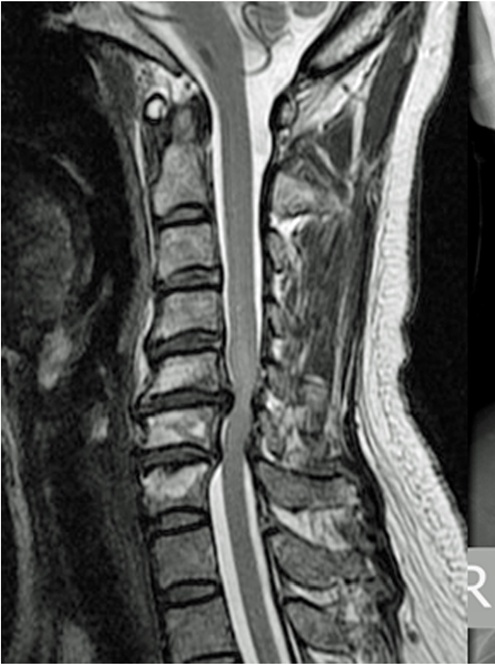Sagittal T2 with effaced CSF at C5-6 and C6-7