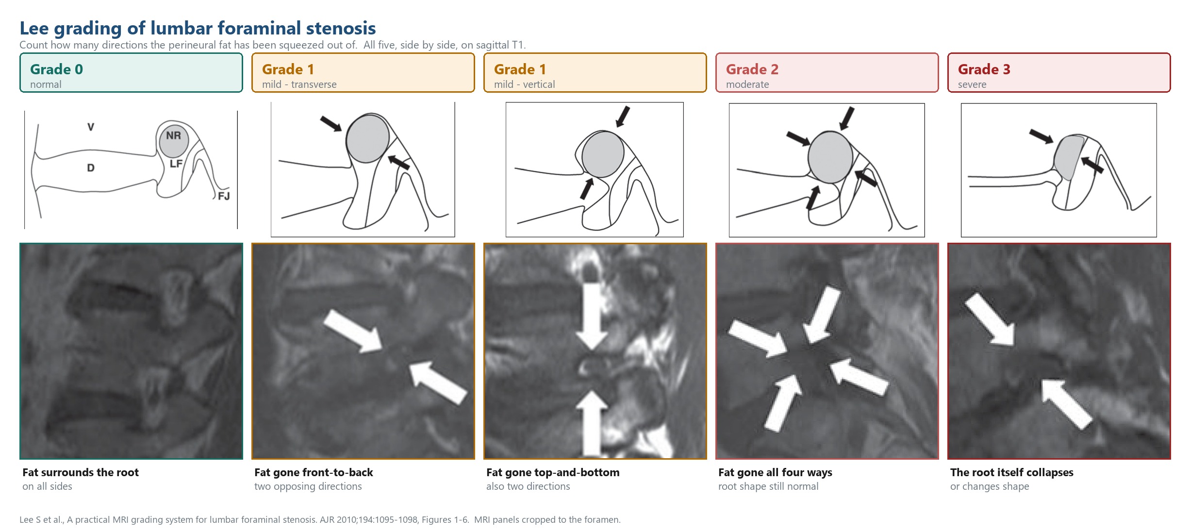 All five Lee grades side by side: schematic above, zoomed MRI below