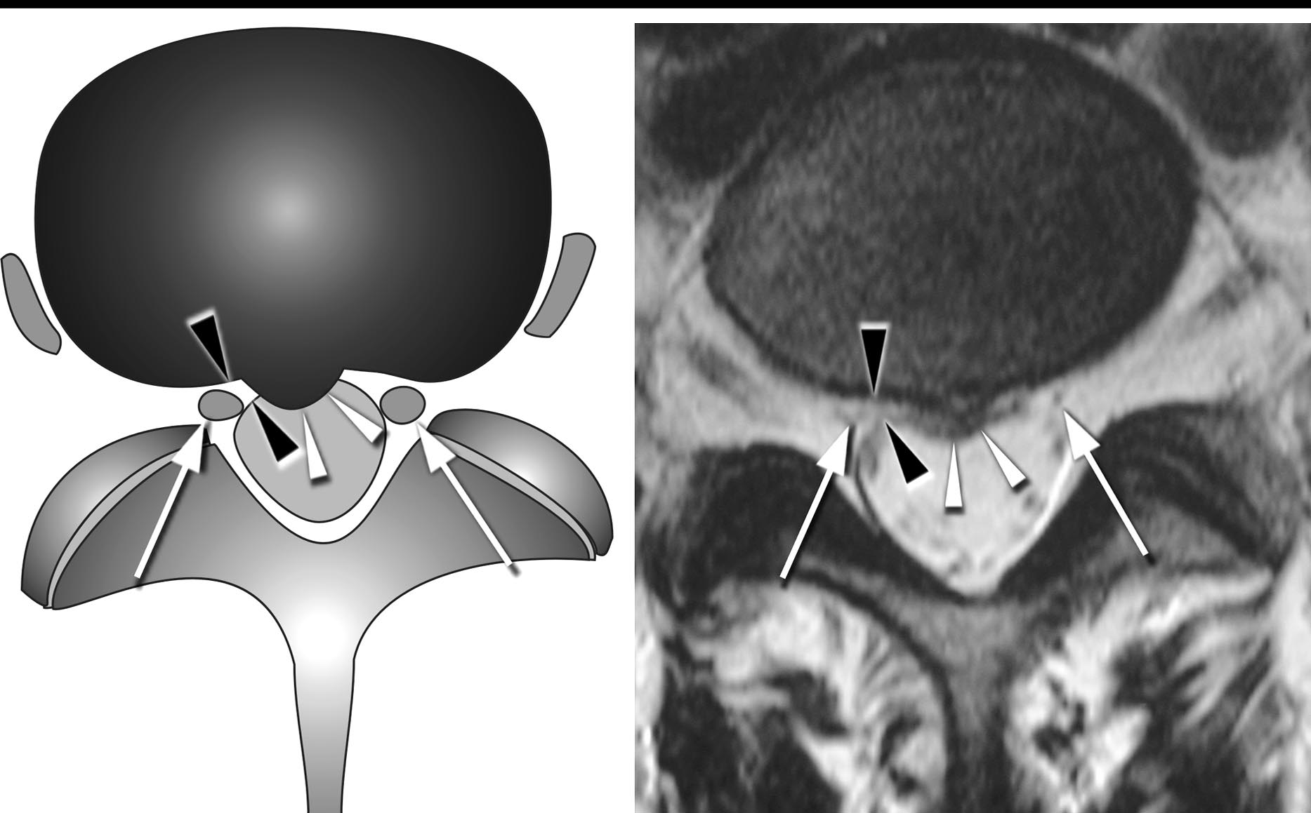 Diagram and axial T2 showing a normal nerve root
