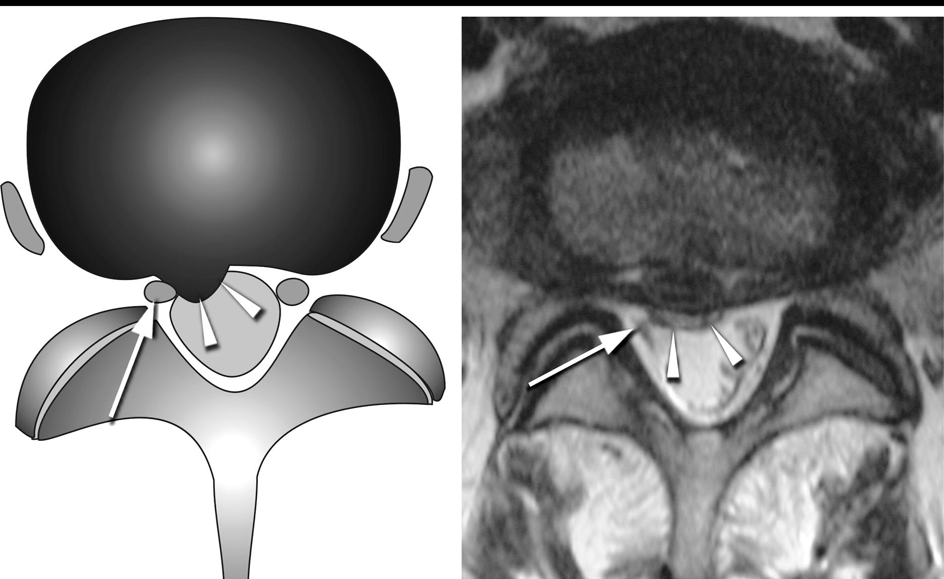Diagram and axial T2 showing disc material contacting the nerve root