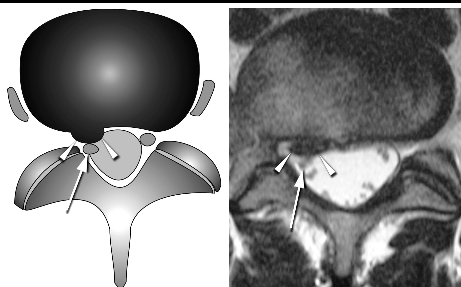 Diagram and axial T2 showing the nerve root deviated dorsally