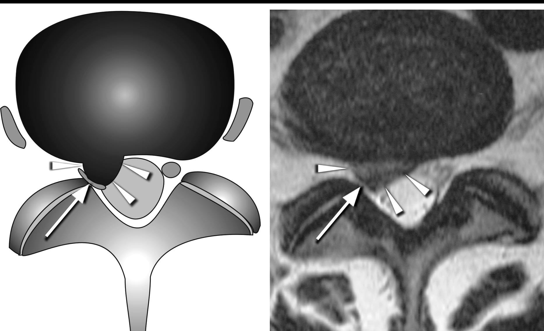 Diagram and axial T2 showing the nerve root compressed and flattened