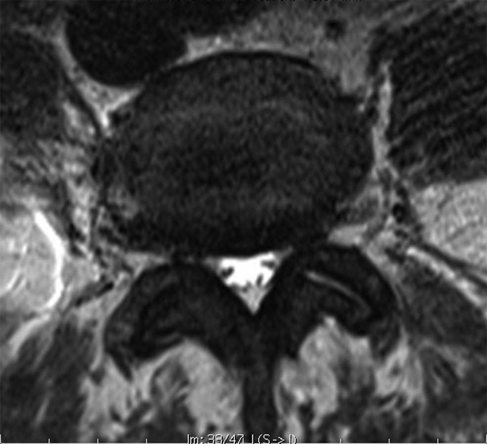Axial T2 at L4-L5, dural sac area 66 square millimetres but grade A morphology