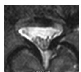 Axial T2, Schizas grade A
