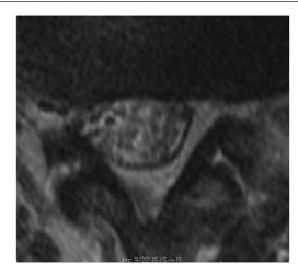 Axial T2, Schizas grade B