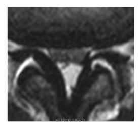 Axial T2, Schizas grade C