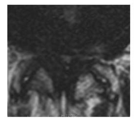 Axial T2, Schizas grade D