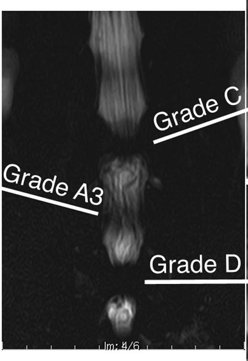 Coronal MR myelogram showing the cerebrospinal fluid column interrupted at two levels