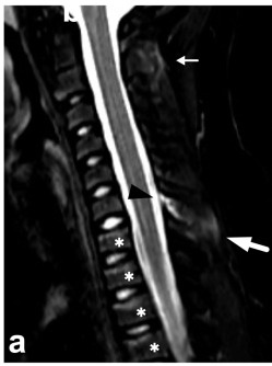 Sagittal STIR cervical spine