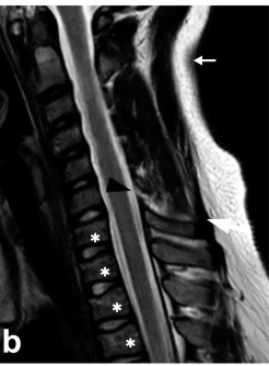 Sagittal T2 cervical spine