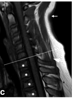 Sagittal T1 cervical spine