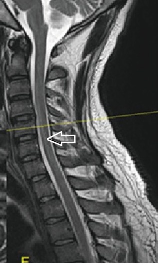 Sagittal T2 with a central bright line in the cord