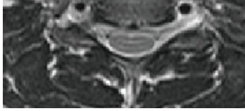 Axial T2 showing the lip sign